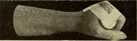 An illustration from Fractures and dislocations, diagnosis and treatment (1915)