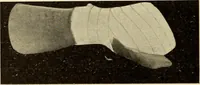 An illustration from Fractures and dislocations, diagnosis and treatment (1915)