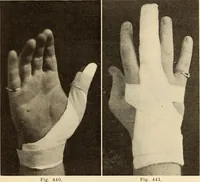 Picture 234 of 481 from Fractures and dislocations, diagnosis and treatment (1915), leaf 340