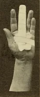 An illustration from Fractures and dislocations, diagnosis and treatment (1915)