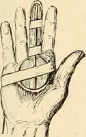 An illustration from Fractures and dislocations, diagnosis and treatment (1915)