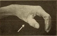 An illustration from Fractures and dislocations, diagnosis and treatment (1915)