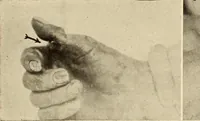 Picture 239 of 481 from Fractures and dislocations, diagnosis and treatment (1915), leaf 346