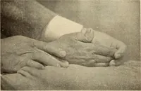 An illustration from Fractures and dislocations, diagnosis and treatment (1915)