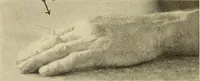 An illustration from Fractures and dislocations, diagnosis and treatment (1915)