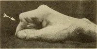 Picture 242 of 481 from Fractures and dislocations, diagnosis and treatment (1915), leaf 347