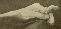 An illustration from Fractures and dislocations, diagnosis and treatment (1915)
