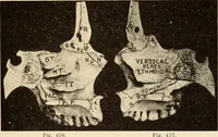 An illustration from Fractures and dislocations, diagnosis and treatment (1915)