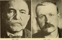 An illustration from Fractures and dislocations, diagnosis and treatment (1915)