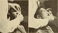 Picture 251 of 481 from Fractures and dislocations, diagnosis and treatment (1915), leaf 360