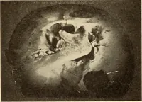 An illustration from Fractures and dislocations, diagnosis and treatment (1915)