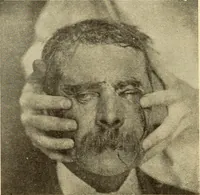 An illustration from Fractures and dislocations, diagnosis and treatment (1915)