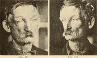 An illustration from Fractures and dislocations, diagnosis and treatment (1915)