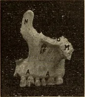 An illustration from Fractures and dislocations, diagnosis and treatment (1915)