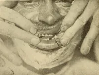 Picture 263 of 481 from Fractures and dislocations, diagnosis and treatment (1915), leaf 383