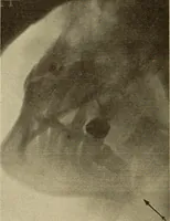 An illustration from Fractures and dislocations, diagnosis and treatment (1915)