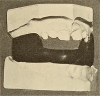 An illustration from Fractures and dislocations, diagnosis and treatment (1915)