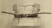 An illustration from Fractures and dislocations, diagnosis and treatment (1915)