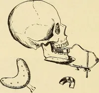 An illustration from Fractures and dislocations, diagnosis and treatment (1915)