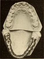 An illustration from Fractures and dislocations, diagnosis and treatment (1915)