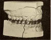 An illustration from Fractures and dislocations, diagnosis and treatment (1915)