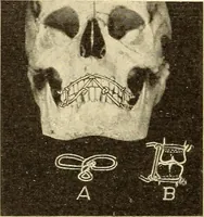 An illustration from Fractures and dislocations, diagnosis and treatment (1915)