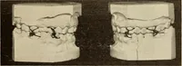 An illustration from Fractures and dislocations, diagnosis and treatment (1915)