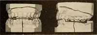 Picture 278 of 481 from Fractures and dislocations, diagnosis and treatment (1915), leaf 402