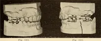 Picture 279 of 481 from Fractures and dislocations, diagnosis and treatment (1915), leaf 402