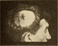 Picture 280 of 481 from Fractures and dislocations, diagnosis and treatment (1915), leaf 418