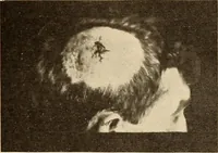 An illustration from Fractures and dislocations, diagnosis and treatment (1915)
