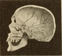An illustration from Fractures and dislocations, diagnosis and treatment (1915)