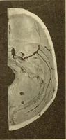 Picture 284 of 481 from Fractures and dislocations, diagnosis and treatment (1915), leaf 429