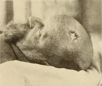 An illustration from Fractures and dislocations, diagnosis and treatment (1915)