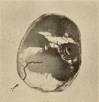 Picture 288 of 481 from Fractures and dislocations, diagnosis and treatment (1915), leaf 446