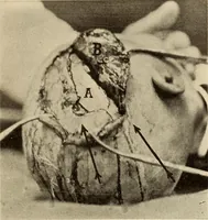 Picture 290 of 481 from Fractures and dislocations, diagnosis and treatment (1915), leaf 448