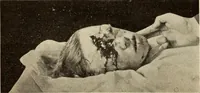 Picture 291 of 481 from Fractures and dislocations, diagnosis and treatment (1915), leaf 448