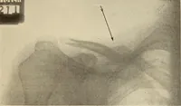 Picture 3 of 481 from Fractures and dislocations, diagnosis and treatment (1915), leaf 46