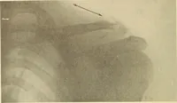 Picture 4 of 481 from Fractures and dislocations, diagnosis and treatment (1915), leaf 47