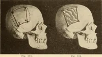 Picture 295 of 481 from Fractures and dislocations, diagnosis and treatment (1915), leaf 478