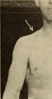 An illustration from Fractures and dislocations, diagnosis and treatment (1915)