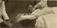 An illustration from Fractures and dislocations, diagnosis and treatment (1915)