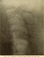 Picture 301 of 481 from Fractures and dislocations, diagnosis and treatment (1915), leaf 491