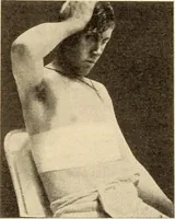 An illustration from Fractures and dislocations, diagnosis and treatment (1915)