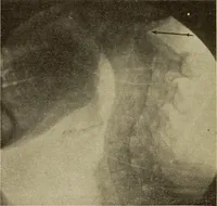An illustration from Fractures and dislocations, diagnosis and treatment (1915)