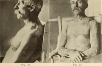 Picture 9 of 481 from Fractures and dislocations, diagnosis and treatment (1915), leaf 50