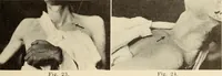 Picture 10 of 481 from Fractures and dislocations, diagnosis and treatment (1915), leaf 50