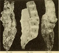 An illustration from Fractures and dislocations, diagnosis and treatment (1915)