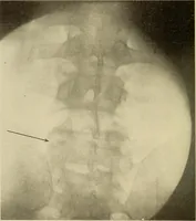 An illustration from Fractures and dislocations, diagnosis and treatment (1915)