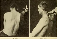 Picture 308 of 481 from Fractures and dislocations, diagnosis and treatment (1915), leaf 505